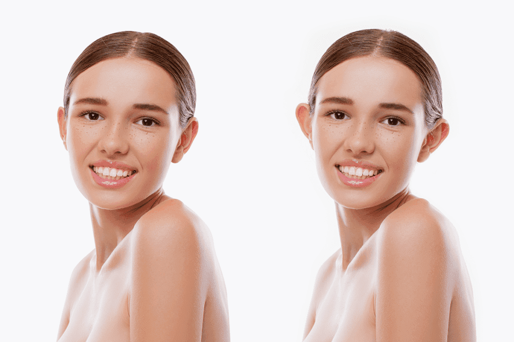Was ist die Operation des abstehenden Ohres (Otoplastik)?