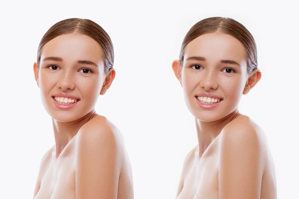 Kepçe Kulak Ameliyatı (Otoplasti) Nedir? Kepçe Kulak Ameliyatı (Otoplasti) Nedir?