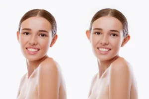 Was ist die Operation des abstehenden Ohres (Otoplastik)?