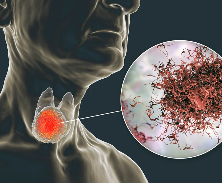 Baş Boyun Kanserleri: Nedir, Nedenleri, Belirtileri ve Tedavisi
