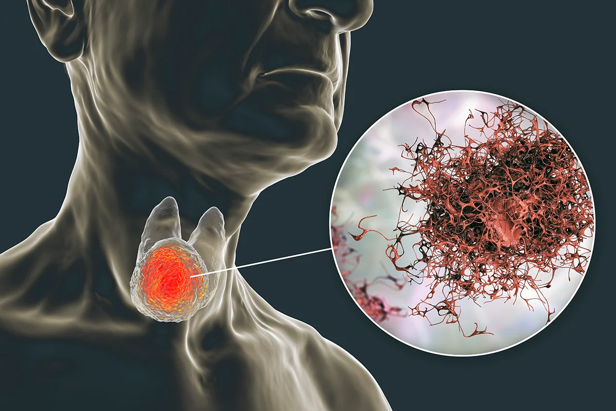 Baş Boyun Kanserleri: Nedir, Nedenleri, Belirtileri ve Tedavisi