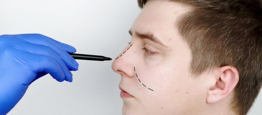 تجميل الأنف الأحدب