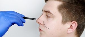 Was ist eine Nasenkorrektur mit Höcker und wie wird sie durchgeführt?