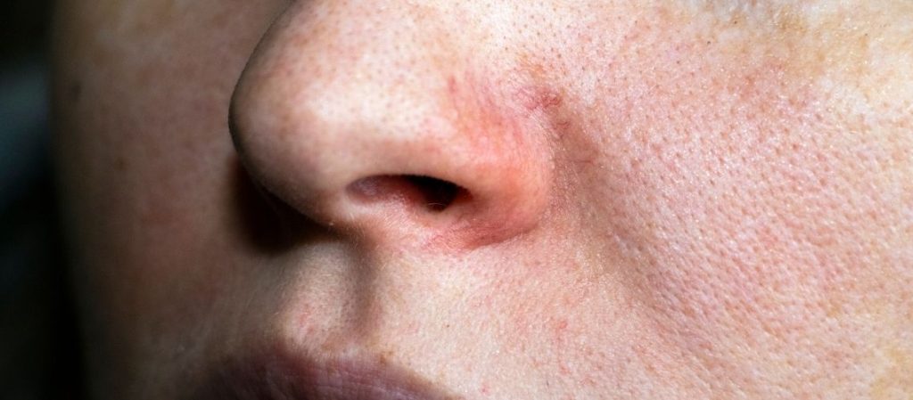 Reparatur einer Septumperforation