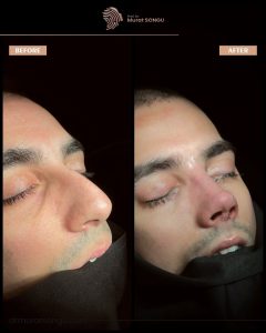 Case Study: Male Rhinoplasty with Chin Implant for Enhanced Facial Harmony