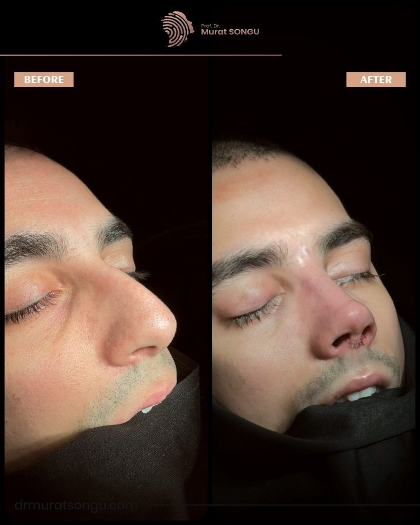Case Study: Male Rhinoplasty with Chin Implant for Enhanced Facial Harmony