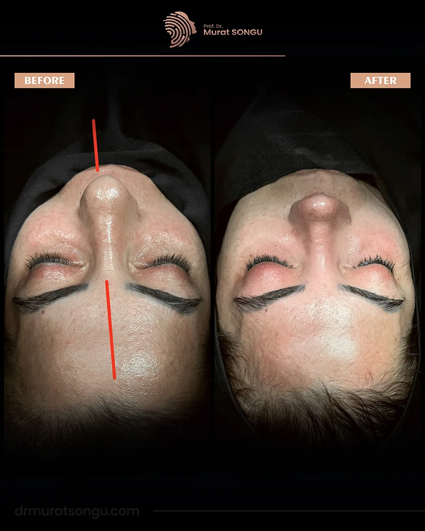 rhinoplasty before after photo 03