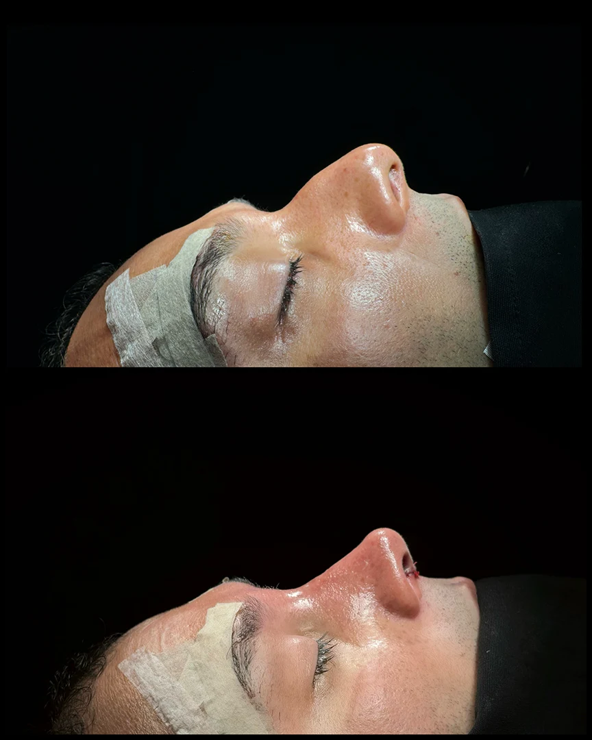 rhinoplasty before after photo 07