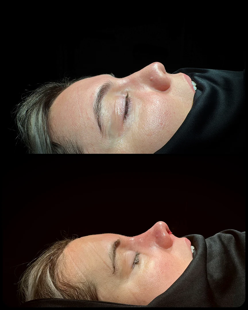 rhinoplasty before after photo 11