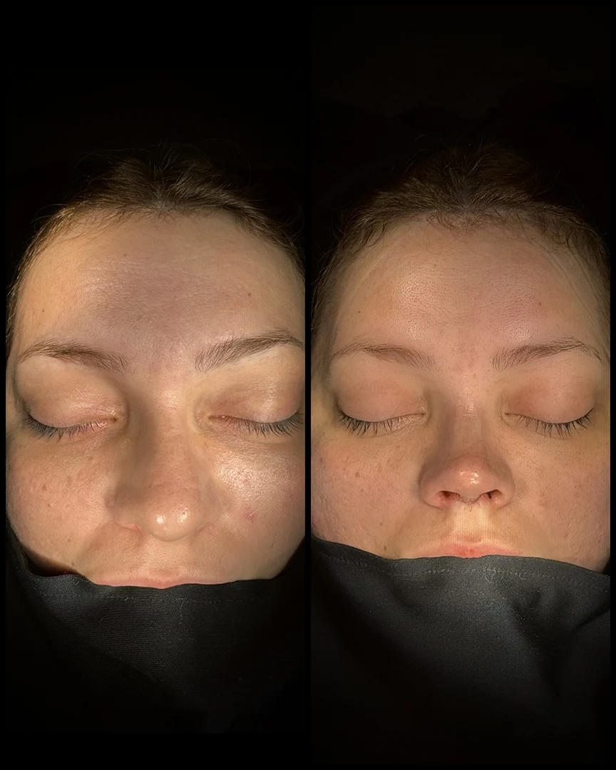 rhinoplasty before after photo 12