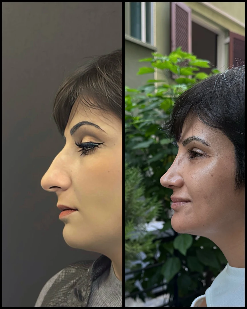 rhinoplasty before after photo 16