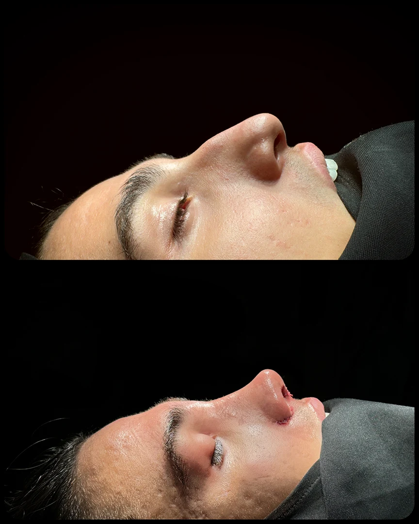 rhinoplasty before after photo 20