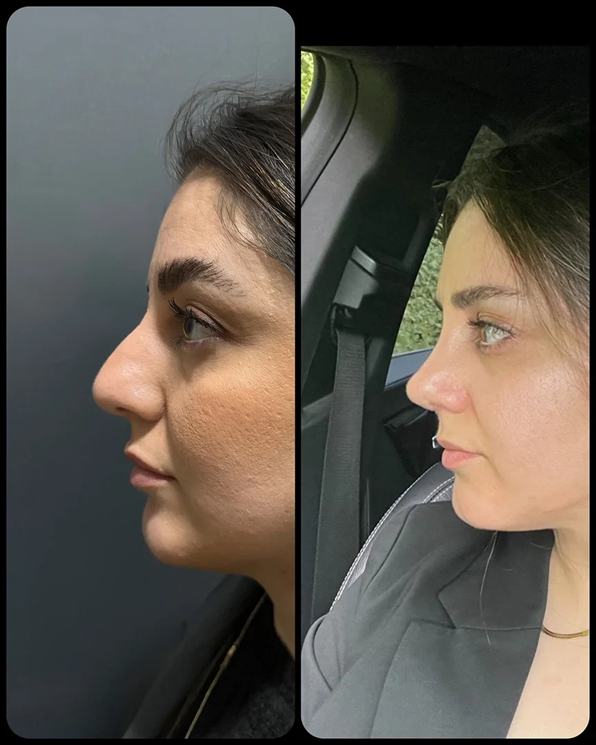 rhinoplasty before after photo 21