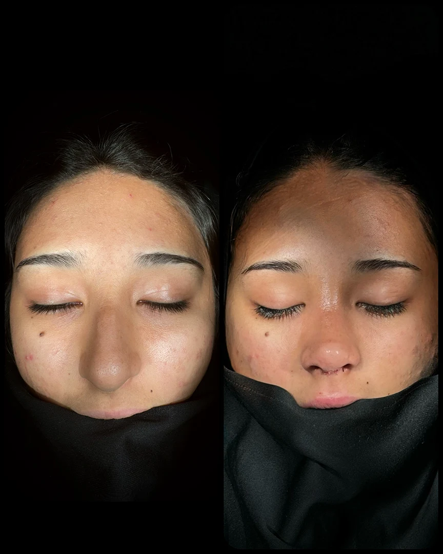 rhinoplasty before after photo 24