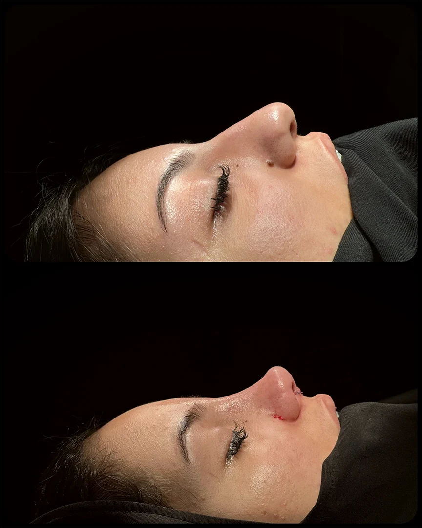 rhinoplasty before after photo 25