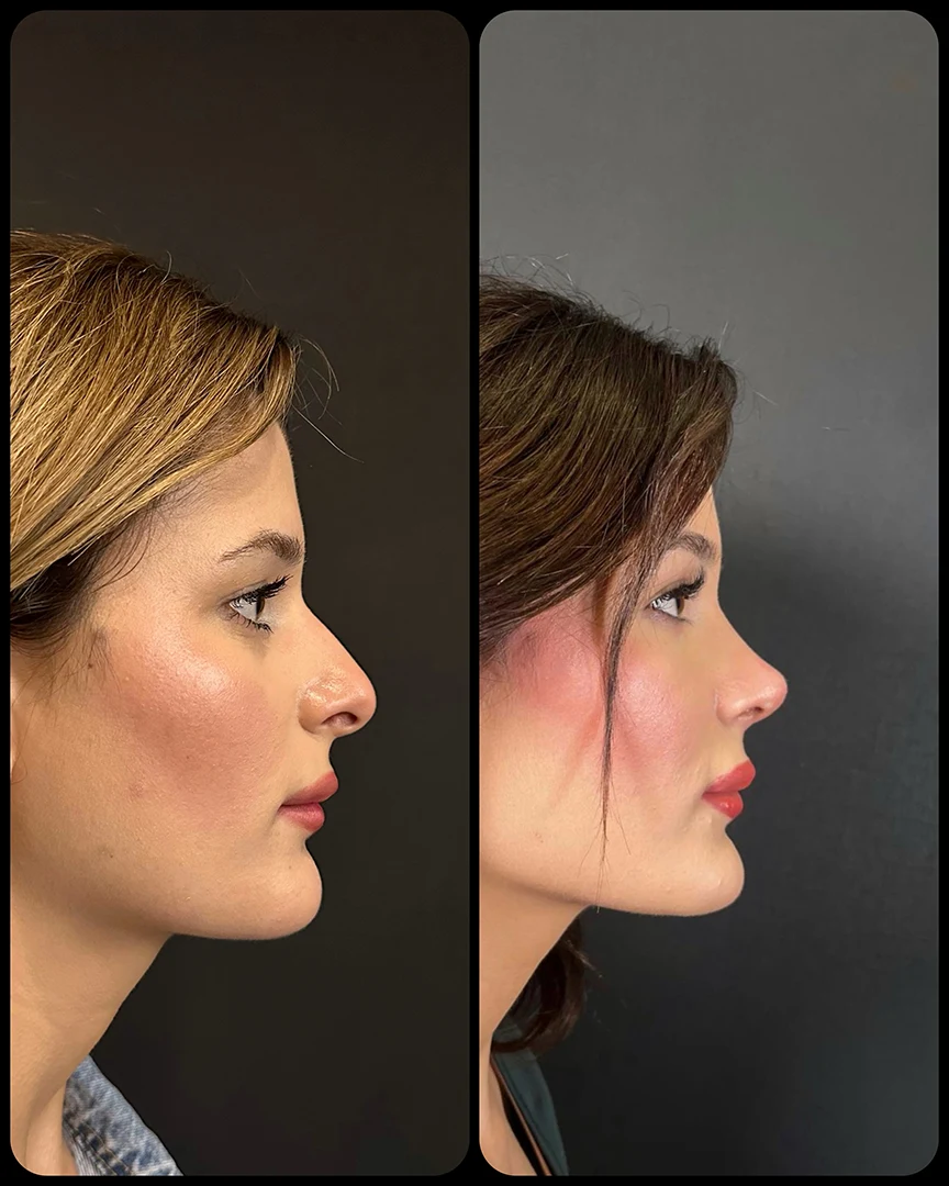 rhinoplasty before after photo 26