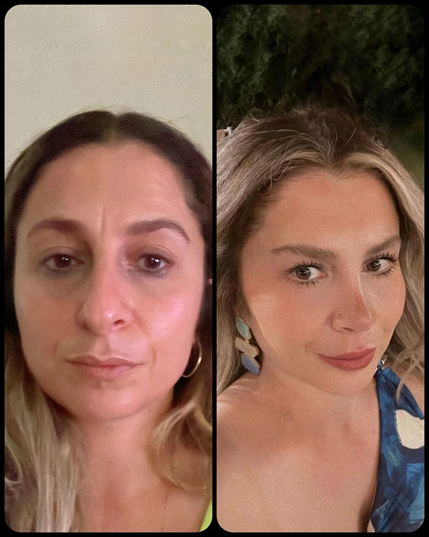 rhinoplasty before after photo 27