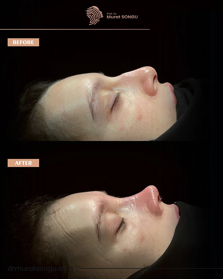 rhinoplasty before after photo 34