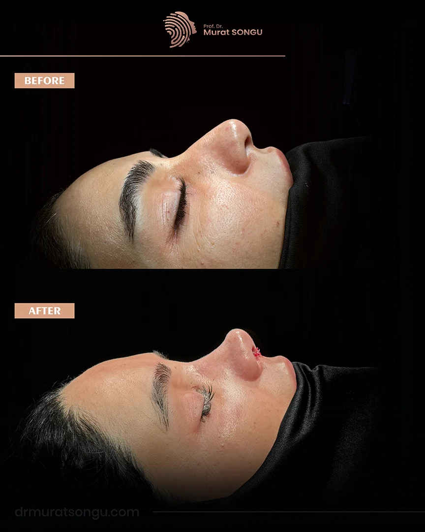 rhinoplasty before after photo 35