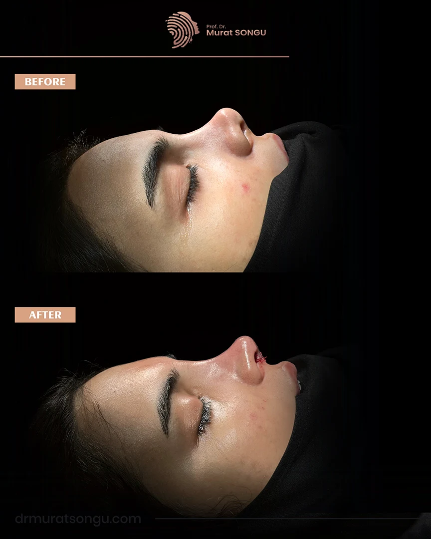 rhinoplasty before after photo 43