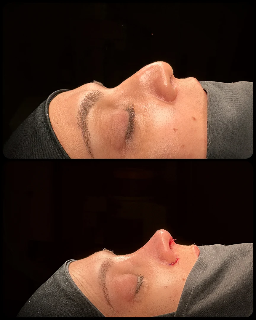 rhinoplasty before after photo 46