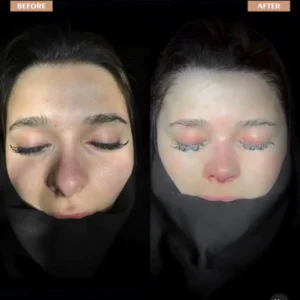 Crooked Nose Surgery Before & After Photos Gallery
