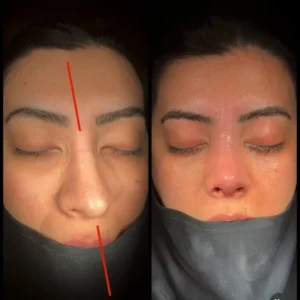 Crooked Nose Surgery Before & After Photos Gallery