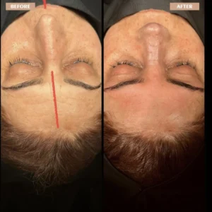Crooked Nose Surgery Before & After Photos Gallery
