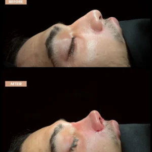 Male Rhinoplasty Before and After Photos