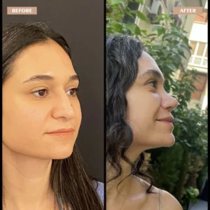 Primary Rhinoplasty Before & After