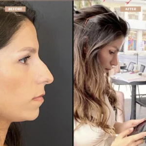 Primary Rhinoplasty Before & After