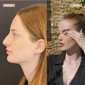 Primary Rhinoplasty Before & After