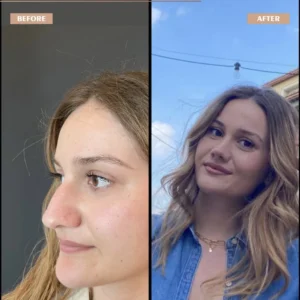 Primary Rhinoplasty Before & After