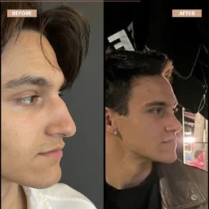 Primary Rhinoplasty Before & After
