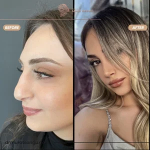Primary Rhinoplasty Before & After