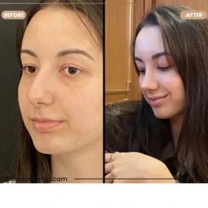 Primary Rhinoplasty Before & After