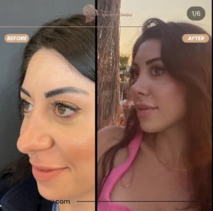 Primary Rhinoplasty Before & After