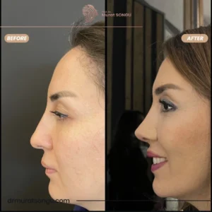 Primary Rhinoplasty Before & After