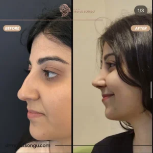 Primary Rhinoplasty Before & After