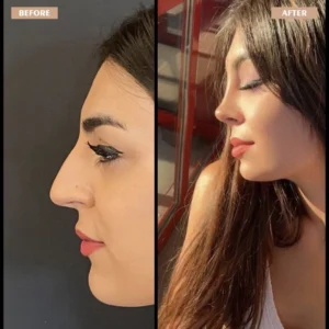 Primary Rhinoplasty Before & After