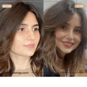 Primary Rhinoplasty Before & After