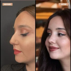 Primary Rhinoplasty Before & After