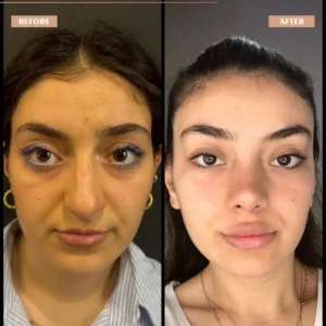 Primary Rhinoplasty Before & After