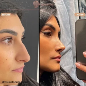 Primary Rhinoplasty Before & After