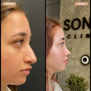 Primary Rhinoplasty Before & After