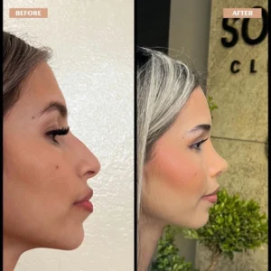 Primary Rhinoplasty Before & After