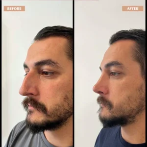 Primary Rhinoplasty Before & After