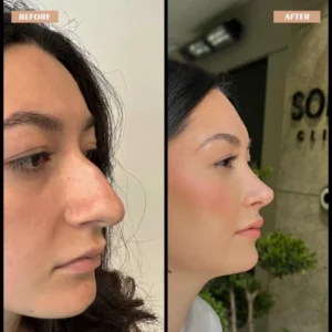 Primary Rhinoplasty Before & After