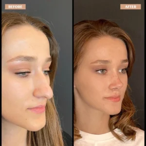 Primary Rhinoplasty Before & After