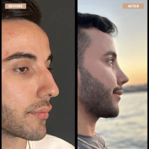 Primary Rhinoplasty Before & After